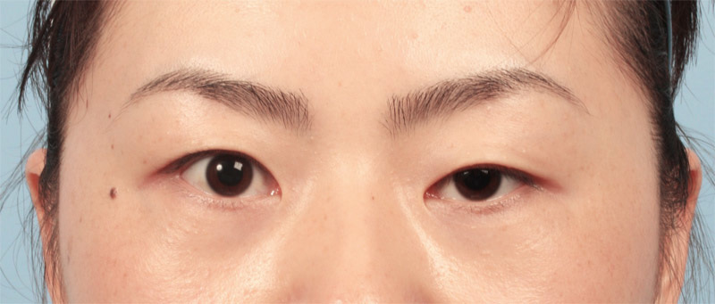 Hồi xuân nhờ phẫu thuật cắt da thừa mí mắt (2)