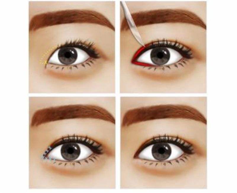 Mở rộng khóe mắt ở đâu cho mắt to và đẹp hơn? (6)