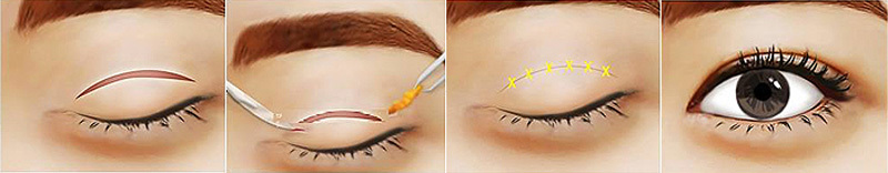 Mắt có nhiều da chùng biến mất nhanh sau 50 phút (4)